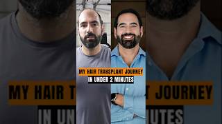 Hair Transplant Transformation in 90 Seconds (No Filters) #hairtransplant #beforeandafter #real