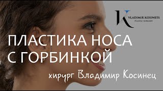 Пластика носа с горбинкой, результат До и После. Реакция пациентки. Хирург Владимир Косинец