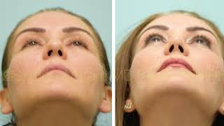 Dallas Rhinoplasty, Fat Transfer, Lower Blepharoplasty, and Lip Microfat Before and After