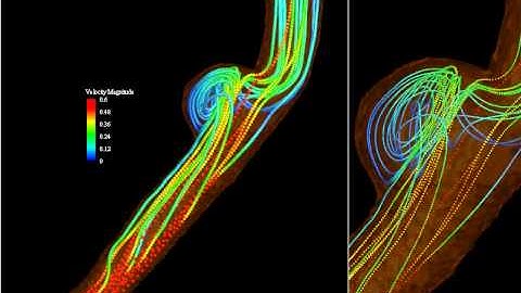 flow simulation around realistic aneurysm model