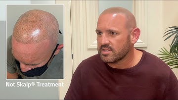 Skalp® fix botched Scalp Micropigmentation treatment.