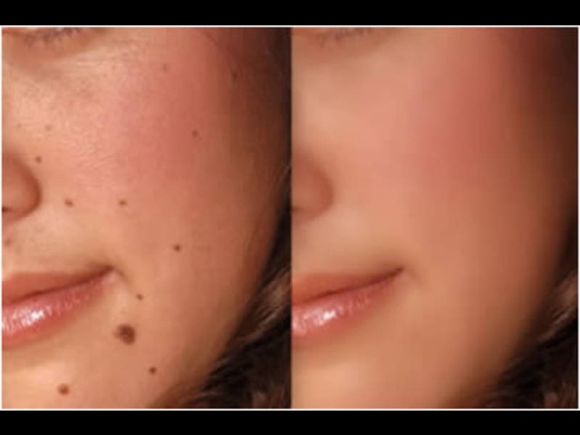 Удаление бородавок и папиллом. Телепередача Россия 1