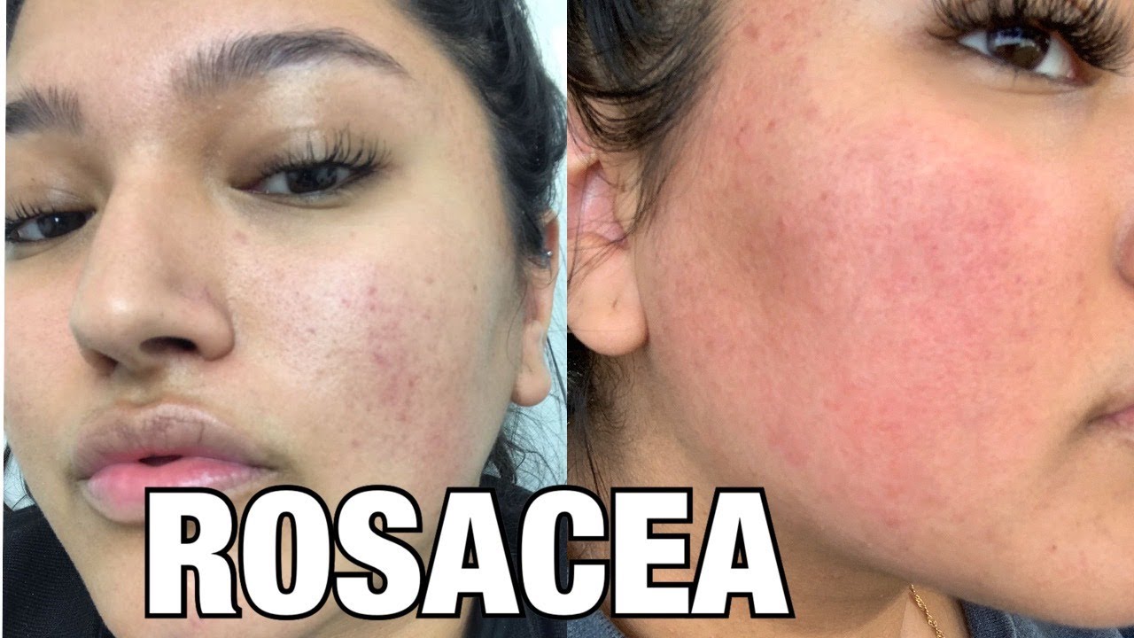 skincare by hyram rosacea