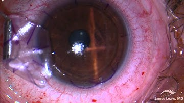 LASIK - Dr. J.S. Lewis - My ideal microkeratome - MORIA - EN