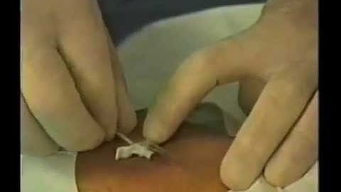 ARROW-INSERCIÓN PERIFÉRICA