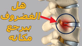 علاج انزلاق الغضروف وعرق النسا بدون جراحه/هل الغضروف بيرجع مكانه بدون عمليه جراحيه؟