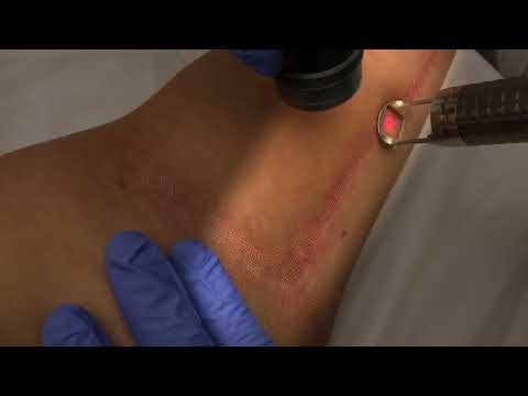Dermatoloji Uzmanı Dr. Sevinç Elinç Aslan'ın  Fraksiyonel Lazer ile yara izleri tedavisi