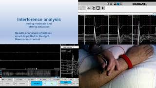 Clinical Demonstration Only   Stalberg QEMG