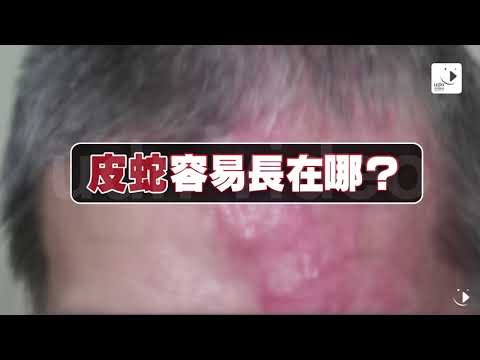 【2017.09.29】影／李新受「皮蛇」折磨？帶狀皰疹抽痛如觸電