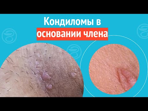 👉 Кондиломы в основании члена. Клинический случай №1462