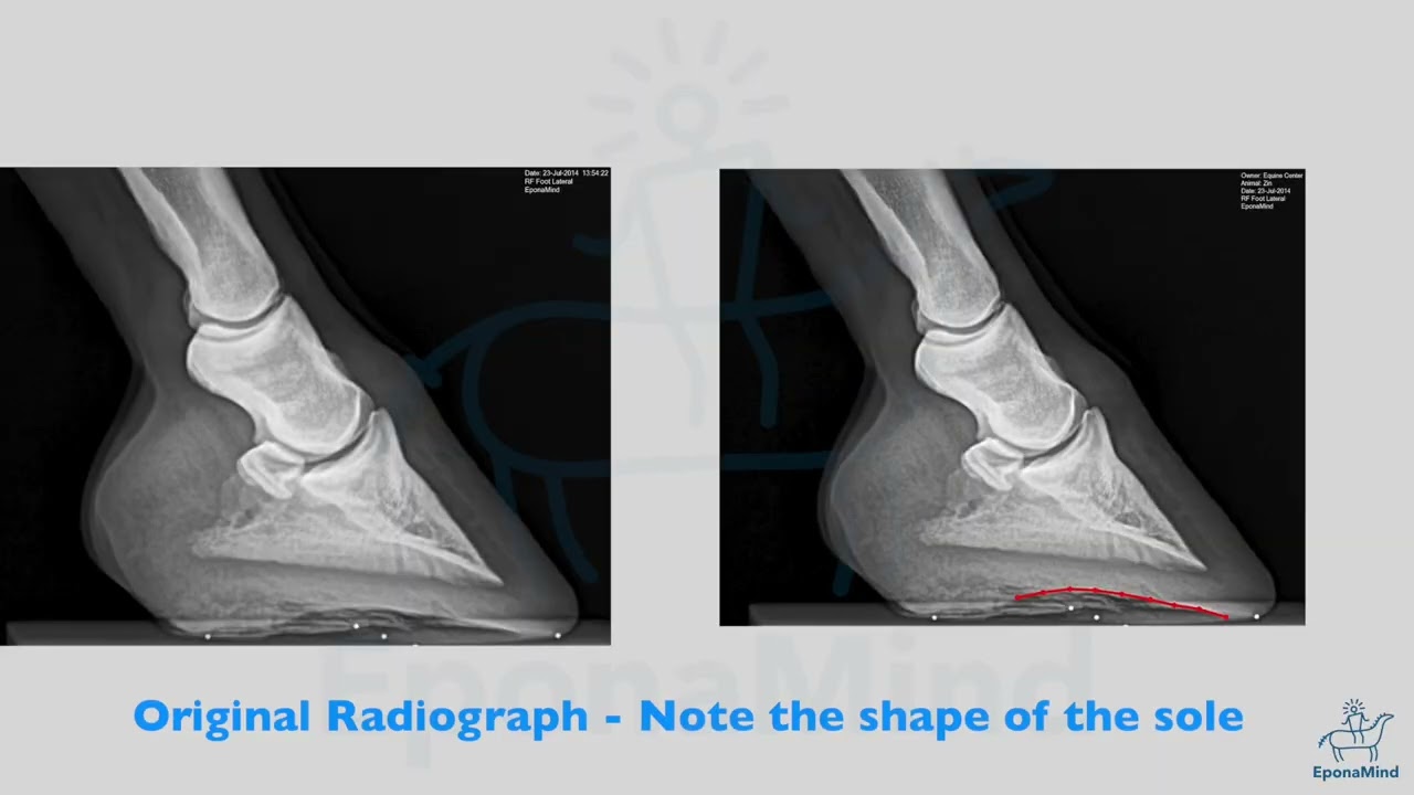 The Effect Improper Load on The Sole And Underlying Tissues