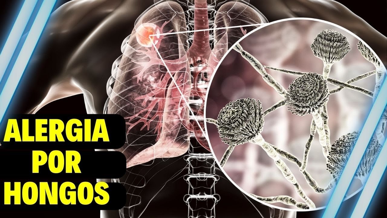 Alergias por hongos en el pulmón: Aspergillosis Pulmonar