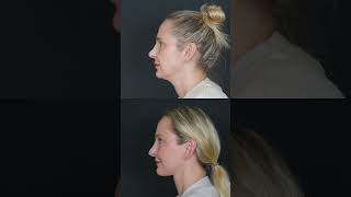 Maria's Facial Rejuvenation — Before &amp; After Results | Dr. Mehmet Cömert