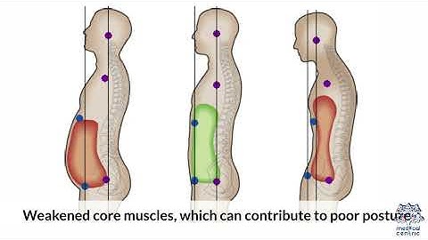 Diastasis Recti: What You Need to Know to Heal Your Core