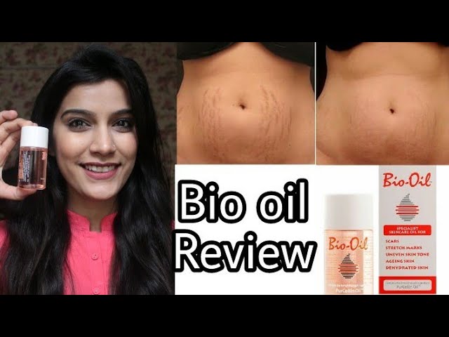 bevestigen echo Amerika Bio Oil Review In Hindi | Remove Stretch Marks/Scars | Super Style Tips -  YouTube