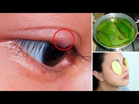 How to Get Rid of a Sty (Stye) - 4 Effective Home Remedies