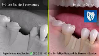 Prótese Fixa 3 Elementos X Implante Dental - Dr. Felipe Boabaid