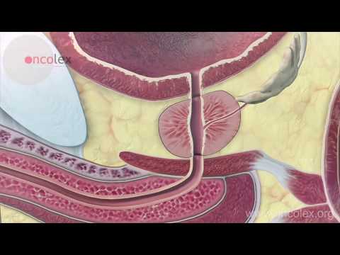 Prostate cancer: Essential facts Hqdefault