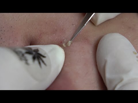 Video Acne Treatment #110 | Around The Mouth & Chin | Linh... - youtube