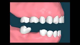 Dental Video of Loss of First Lower Molar Drifting of molars