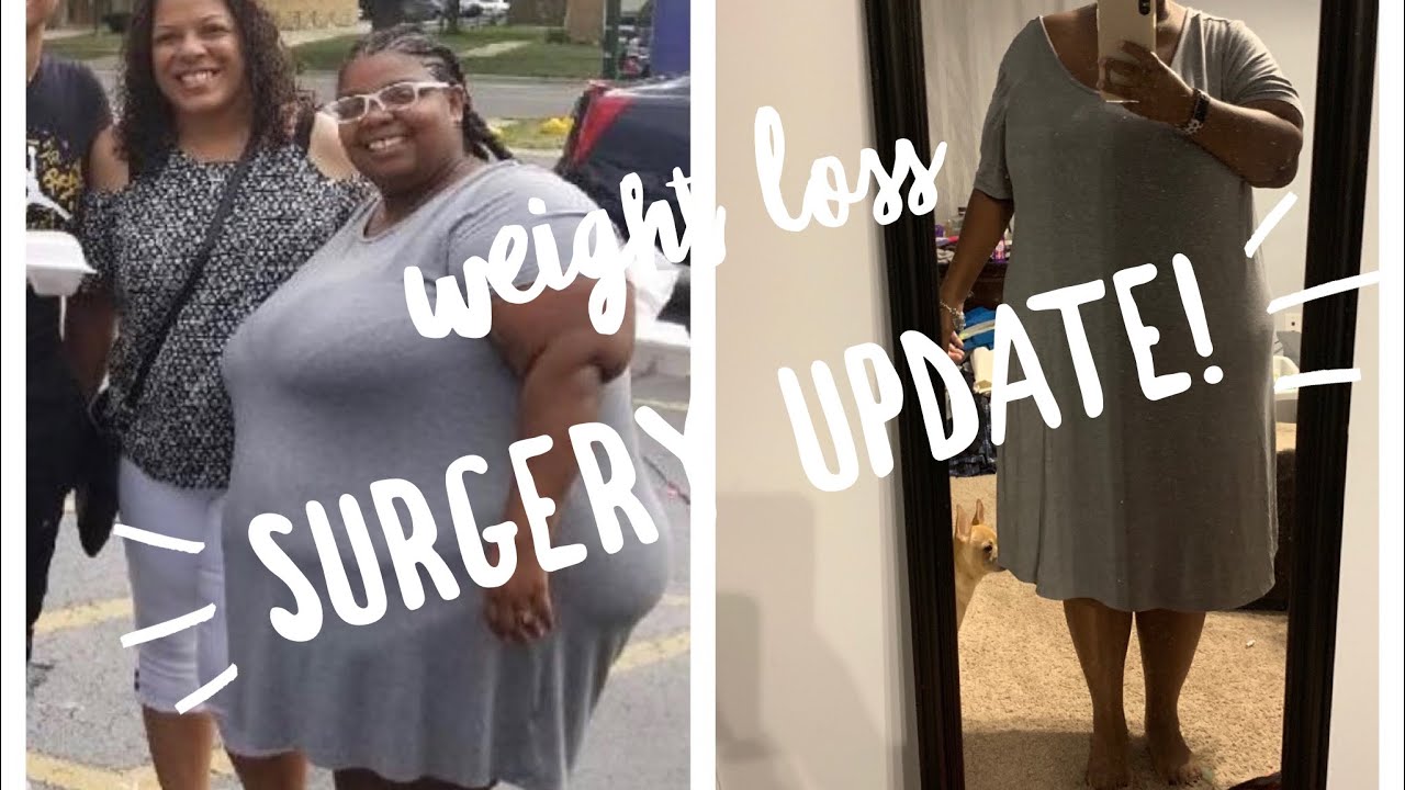 Duodenal Switch Surgery Update YouTube