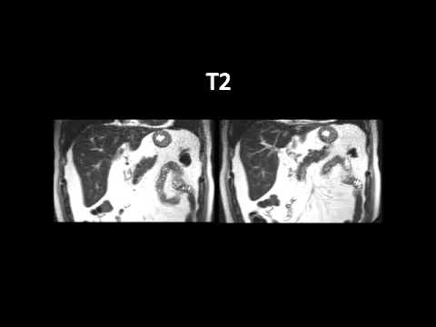 RM do abdomen: T1, T1 Fat-sat sem e com contraste, T2 e T2 Fat-sat