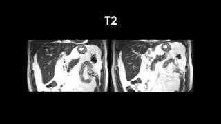 RM do abdomen: T1, T1 Fat-sat sem e com contraste, T2 e T2 Fat-sat