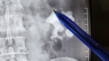 Khi bị sỏi thận, nên làm gì? TTƯT.TS.BS.Dương Văn Trung ☎️0913534343.website:soithan.net.vn