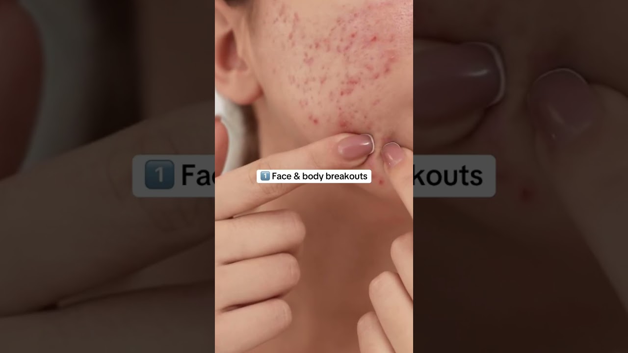 Signs you have elevated androgens or hyperandrogenism