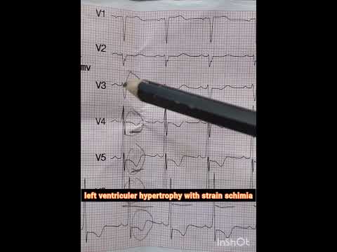 LVH With ST Segment Changes ECG Interpretation Made Easy Education Ecgtrain Auscultation