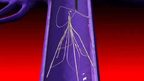 FIS   IVC Filter Retrieval Tulip Jug Retrieval