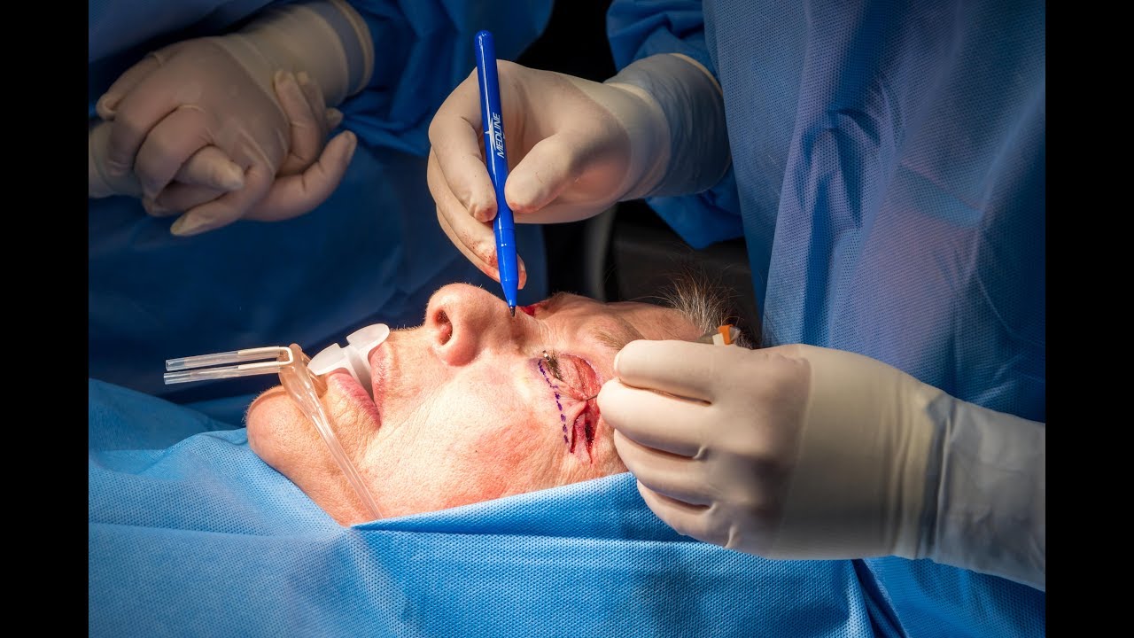 Closing Eye Lid Incision by Dr. Drew at Inspire Cosmetic - YouTube