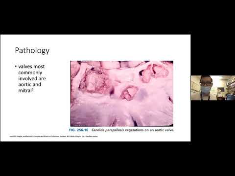 Candida glabrata endocarditis