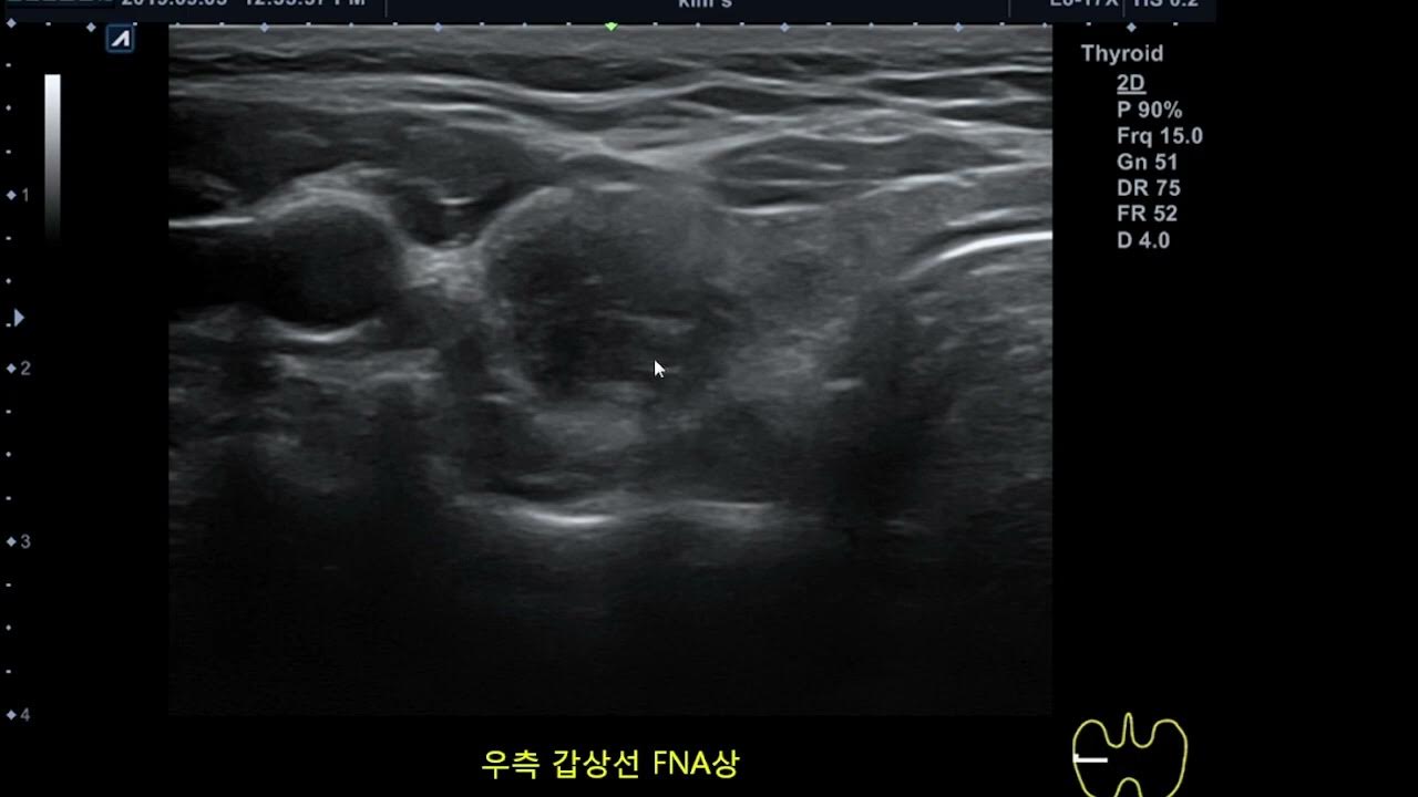  punctate echogenic foci 53 youtube