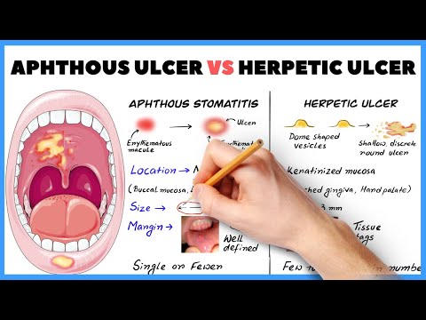 Aphthous ulcer (Aphthous stomatitis) vs Herpetic ulcer : How to diagnose