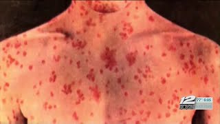 Measles outbreaks reach Texoma, local doctor speaks about vaccines