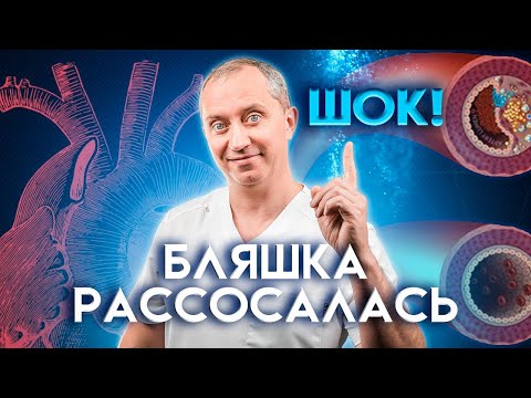 видео: Шок! Бляшка рассосалась! Атеросклероз