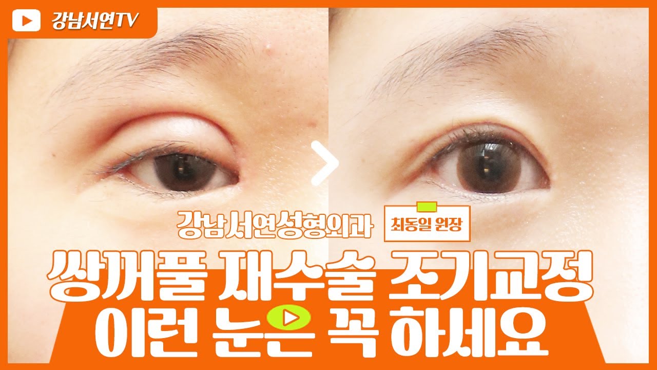 강нам Сэёон гоо сайхны мэс заслын эмнэлэг
Гоо сайхны мэс заслын судлал I
Давхрааны дахин мэс заслын дараа эрт үед нь зайлшгүй залруулга хийх ёстой нүд