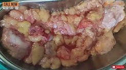 FTM Transgender | Female to Male Surgery ( Top Surgery ) By Dr. Prashant Yadav At Dezire Clinic