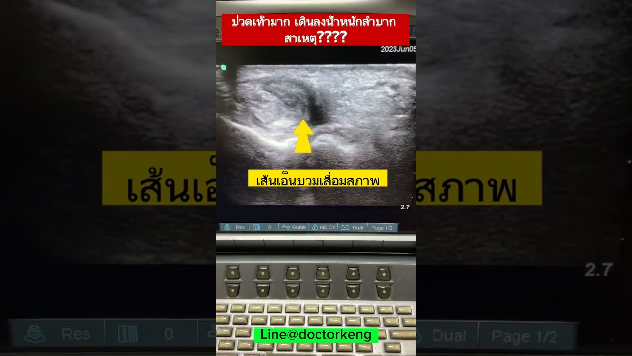 ปวดเท้า #หมอเก่งกระดูกและข้อ #ปวดเท้า #ปวด #เส้นเอ็นอักเสบ #ultrasound