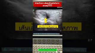 ปวดเท้า #หมอเก่งกระดูกและข้อ #ปวดเท้า #ปวด #เส้นเอ็นอักเสบ #ultrasound