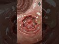 Watch a Stomach Ulcer Form Inside the Human Body | 3D Medical Animation
