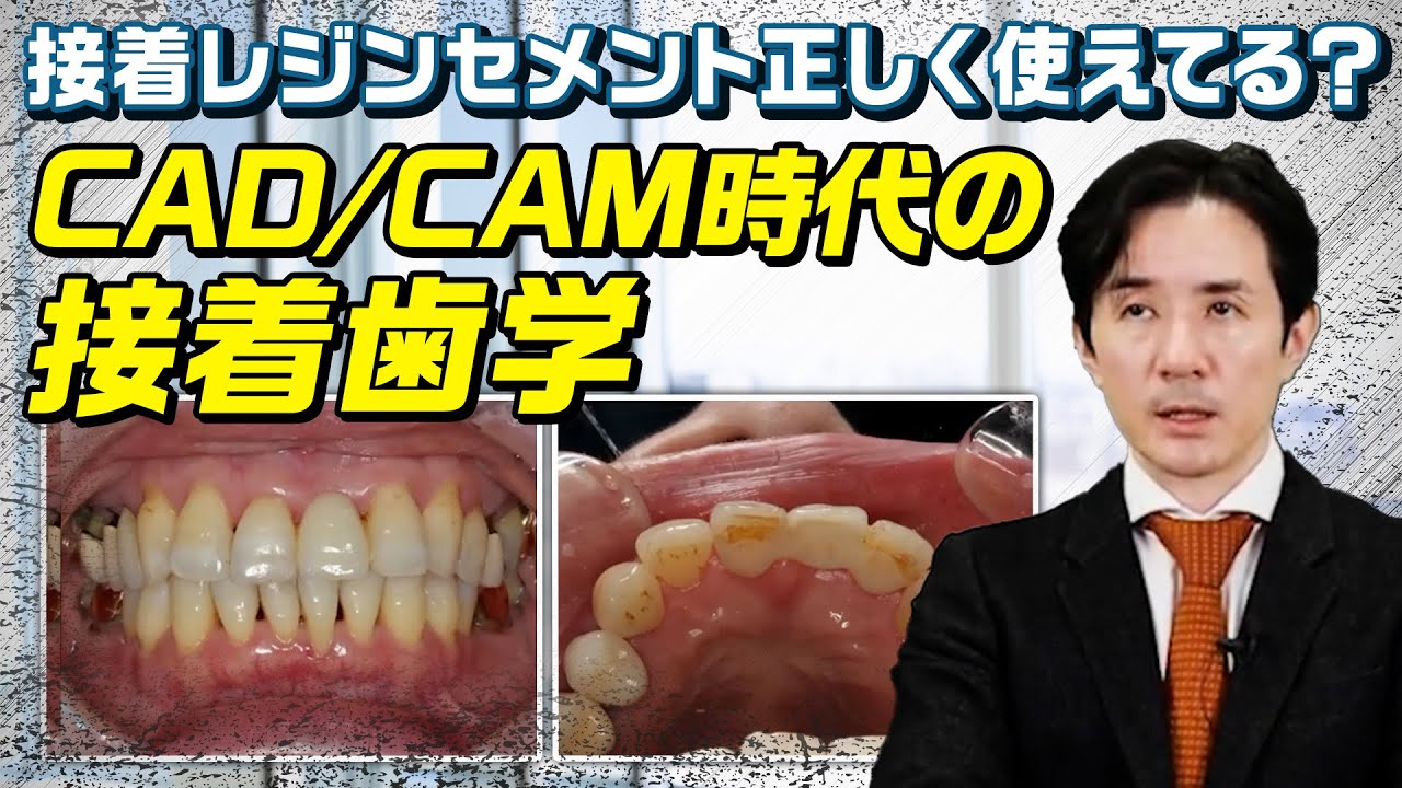 CAD/CAM】補綴物・修復物セットに欠かせないポイント - YouTube