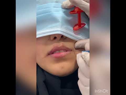 فيلر شفايف