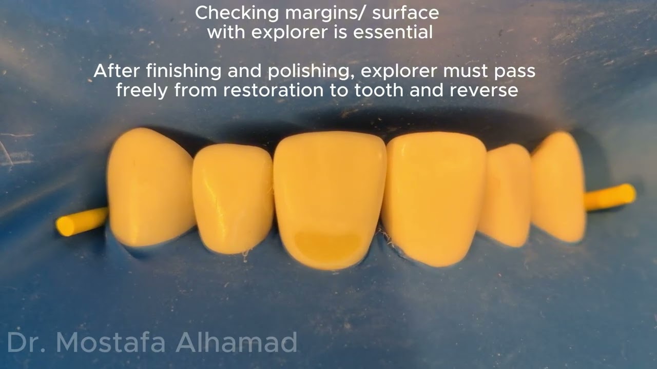 Class V Restoration for preclinical students