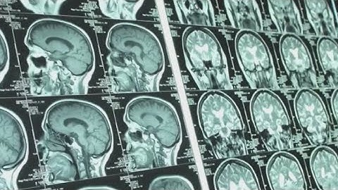 At-home brain zapping grows in popularity  |  NewsNation Prime