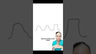 OVER DAMPED ARTERIAL LINE WAVEFORM