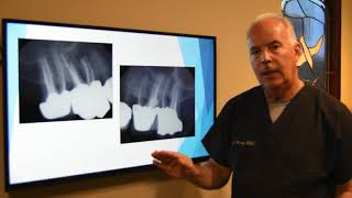 Updated Information on Root Canals and Treatments by Dr Dana Rockey