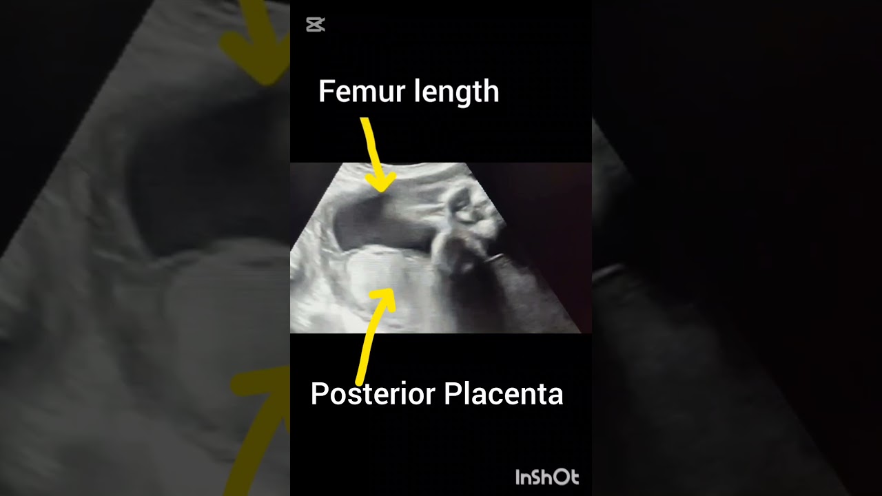 Pregnancy Ultrasound showing femur length! Placenta Position Ultrasound!
