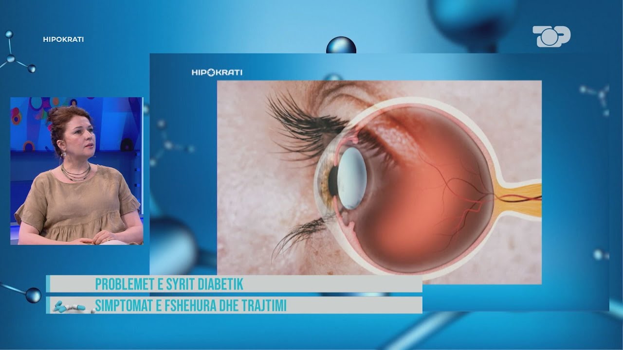 Hipokrati- Si ta zbuloni që keni diabet syri… Këto shenja do ju sinjalizojnë!